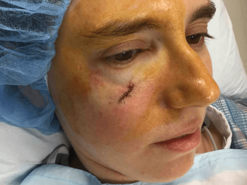 Mohs Face Patient 17 Before - 2