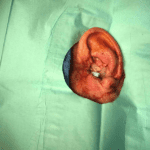 Mohs Ear Patient 10 Thumbnail Before - 2