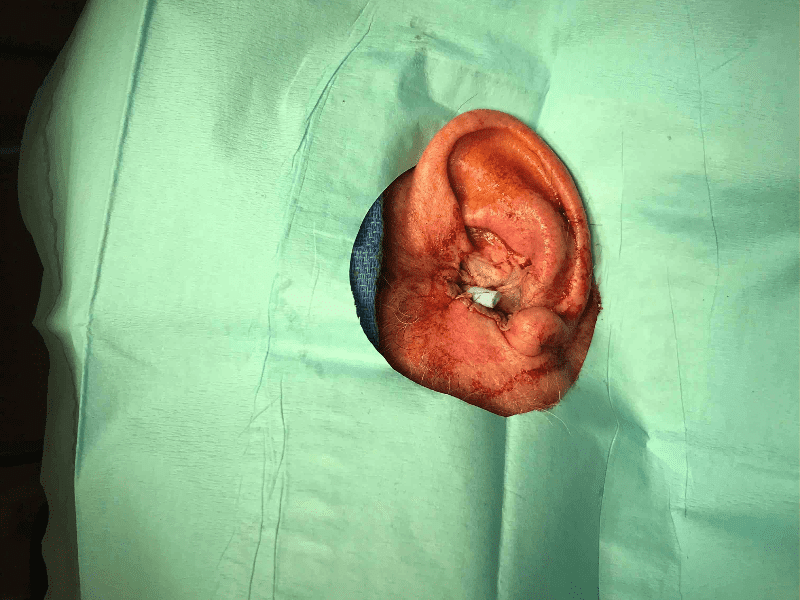 Mohs Ear Patient 10 Before - 2