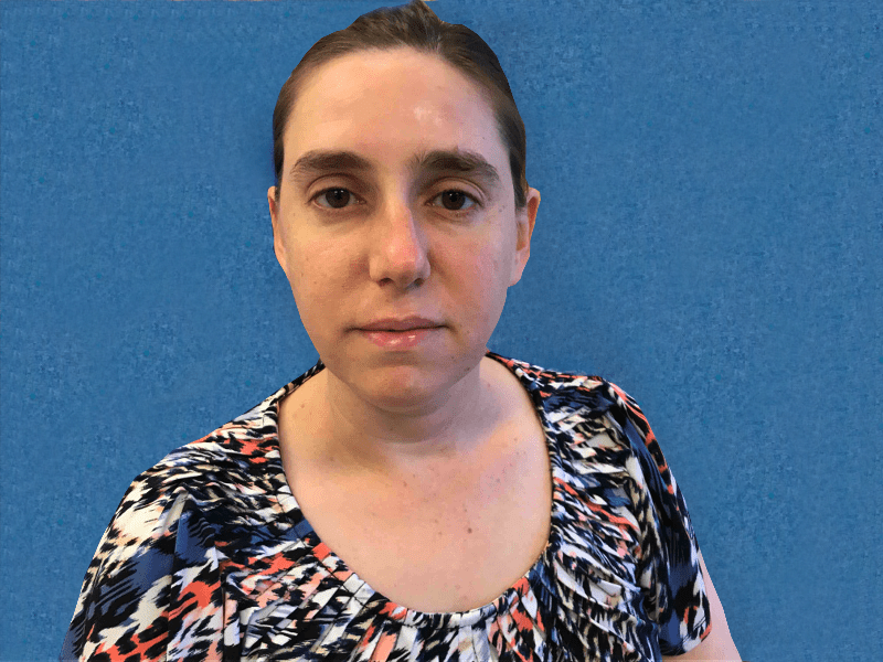 Mohs Lip Patient 12 After - 2