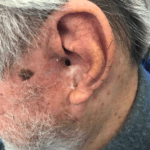 Mohs Ear Patient 10 Thumbnail After - 2