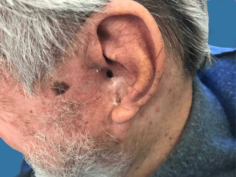 Mohs Ear Patient 10 After - 2