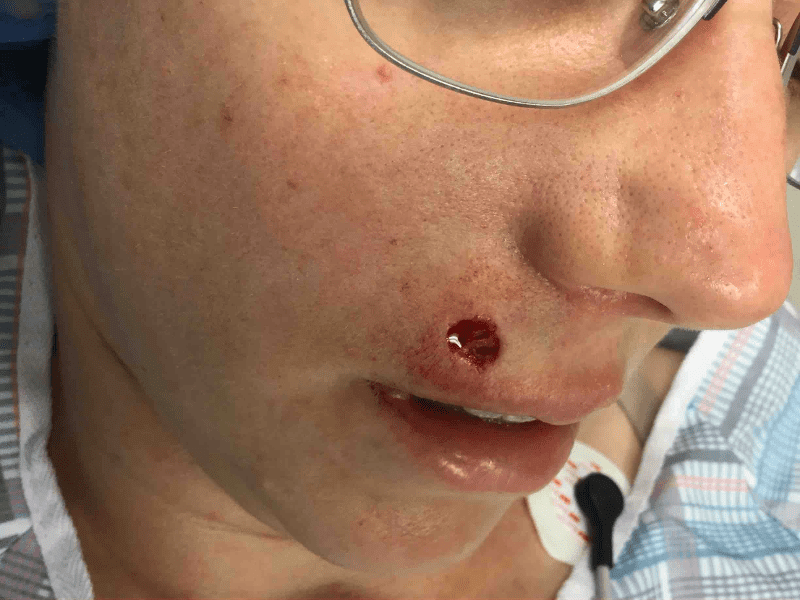 Mohs Lip Patient 12 After