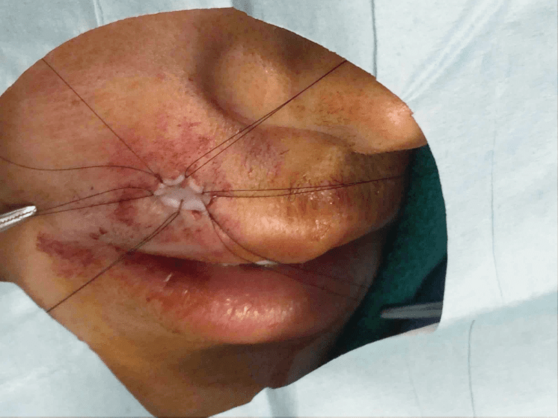 Mohs Lip Patient 12 Before - 2