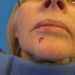 Mohs Face Patient 16 Thumbnail Before