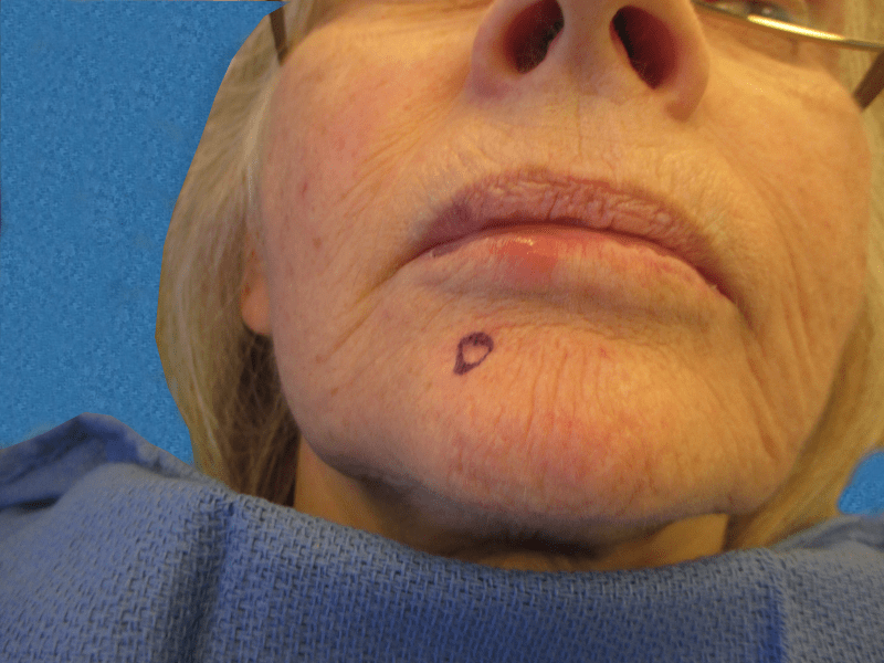 Mohs Face Patient 16 Before