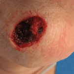 Mohs Face Patient 16 Thumbnail After