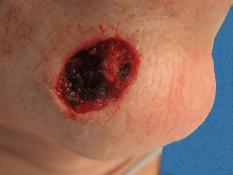 Mohs Face Patient 16 After