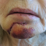 Mohs Face Patient 16 Thumbnail Before - 2