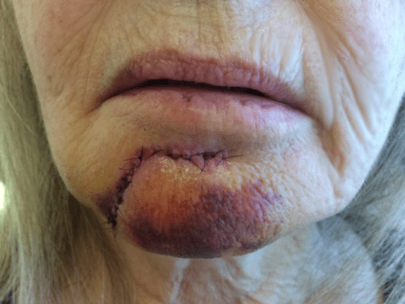 Mohs Face Patient 16 Before - 2