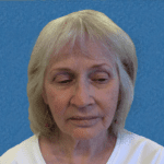 Mohs Face Patient 16 Thumbnail After - 2