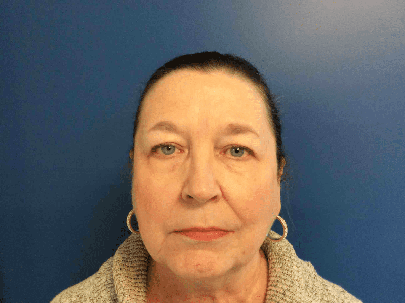 Blepharoplasty Patient 05 Before