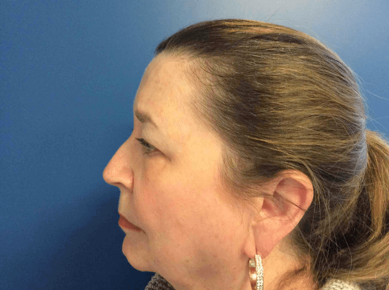 Blepharoplasty Patient 05 After