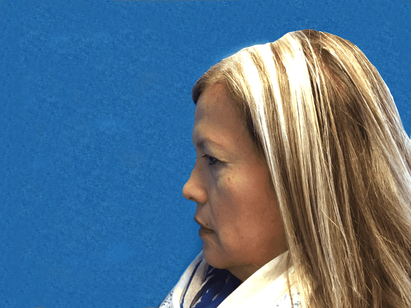 Blepharoplasty Patient 07 After