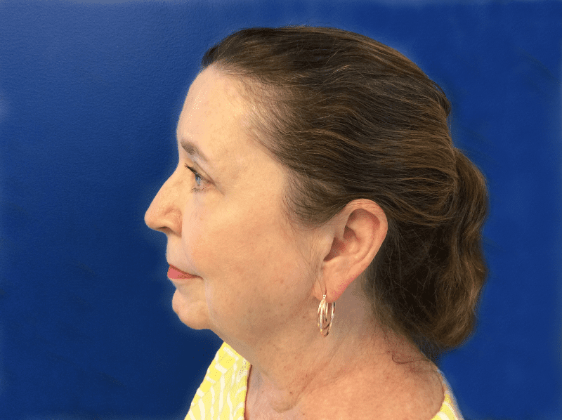 Blepharoplasty Patient 05 After - 2