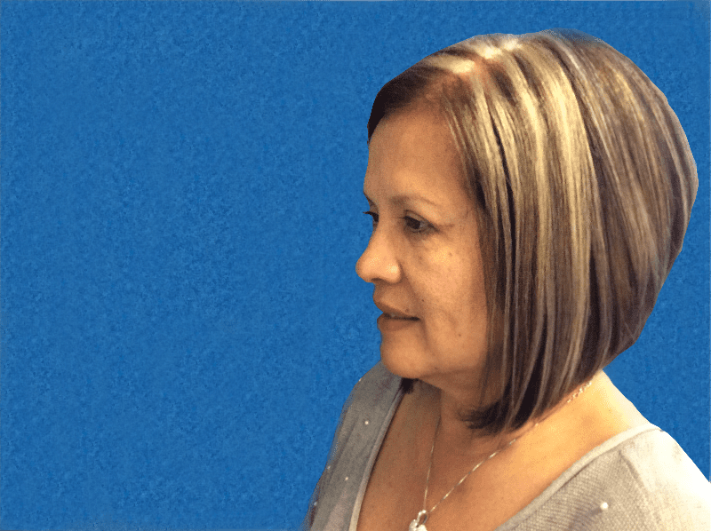 Blepharoplasty Patient 07 After - 2