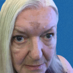 Excision Face Patient 01 Thumbnail Before