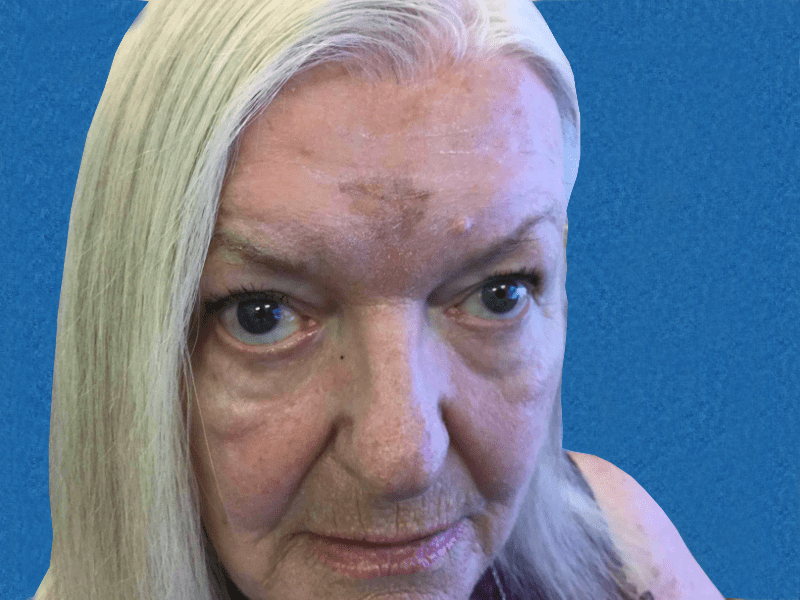 Excision Face Patient 01 Before