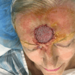 Excision Face Patient 01 Thumbnail After
