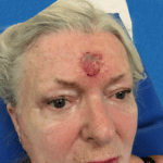 Excision Face Patient 01 Thumbnail Before - 2