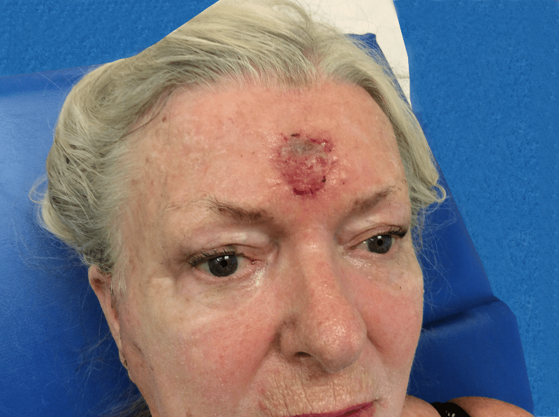 Excision Face Patient 01 Before - 2