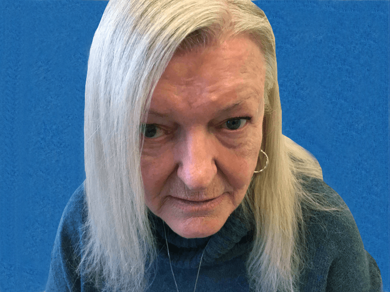 Excision Face Patient 01 After - 2