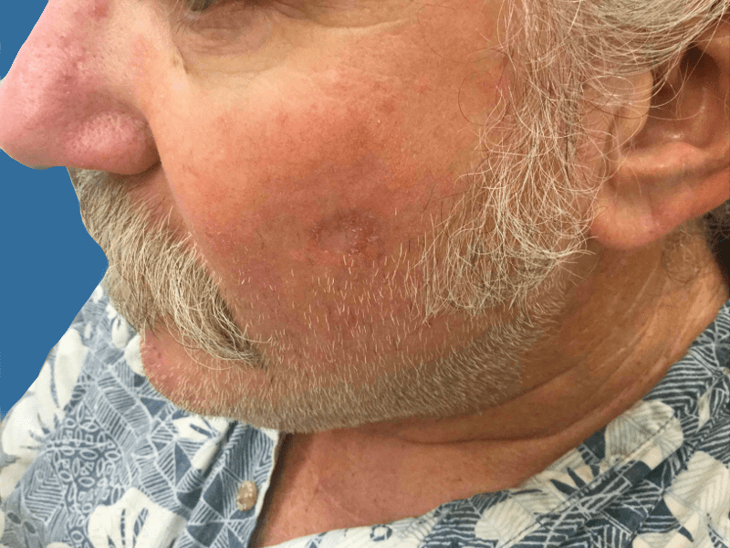 Mohs Face Patient 14 Before