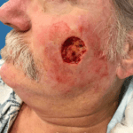 Mohs Face Patient 14 Thumbnail After