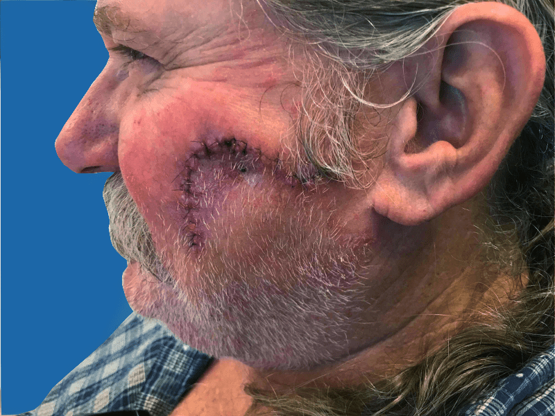 Mohs Face Patient 14 Before - 2