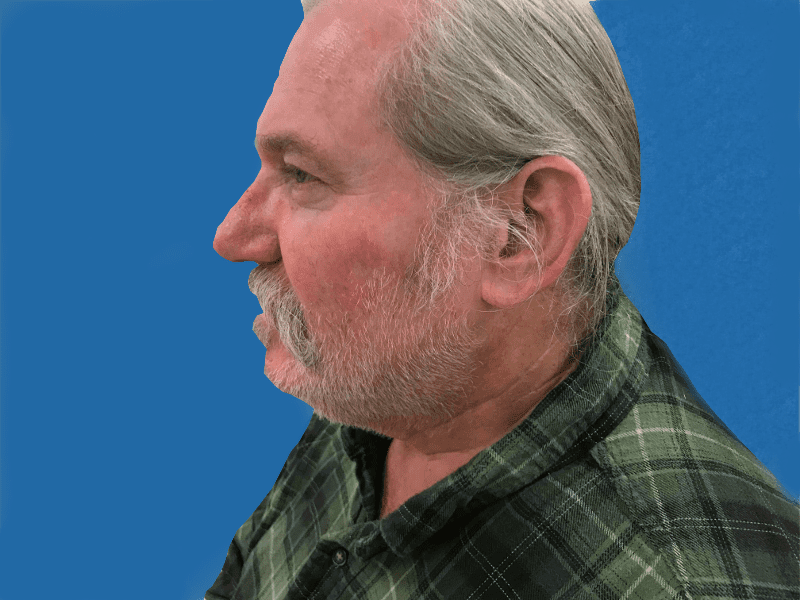 Mohs Face Patient 14 After - 2