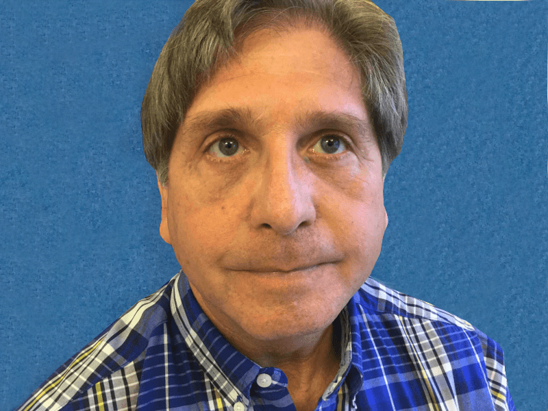 Blepharoplasty Patient 06 After - 2