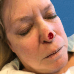 Mohs Nose Patient 24 Thumbnail After