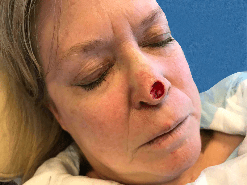 Mohs Nose Patient 24 After