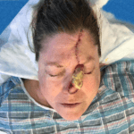 Mohs Nose Patient 24 Thumbnail Before - 2