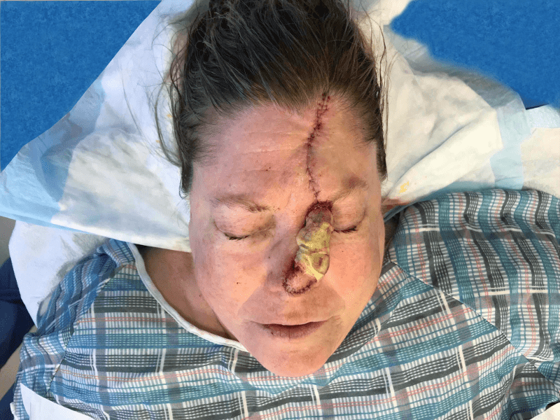 Mohs Nose Patient 24 Before - 2