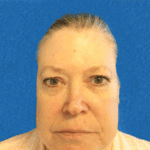 Mohs Nose Patient 24 Thumbnail After - 2