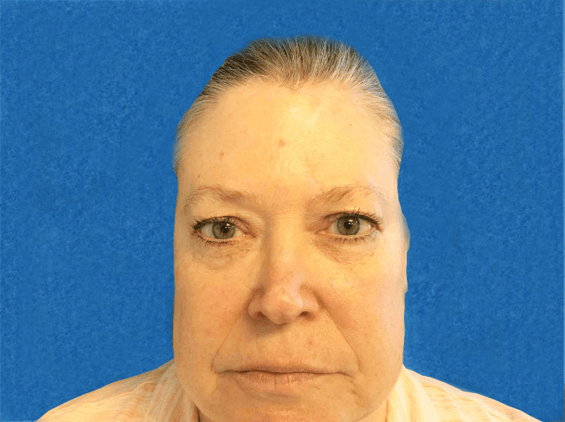 Mohs Nose Patient 24 After - 2