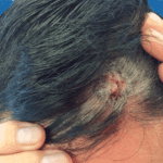 Mohs Patient Scalp 02 Thumbnail Before