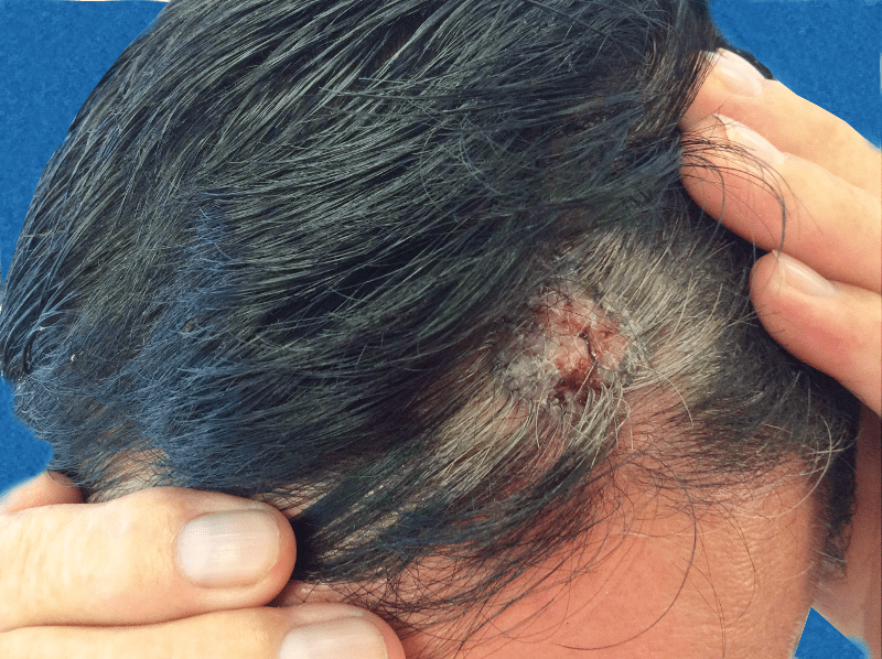 Mohs Patient Scalp 02 Before