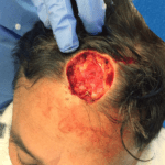 Mohs Patient Scalp 02 Thumbnail After
