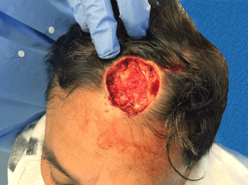 Mohs Patient Scalp 02 After