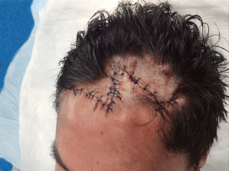 Mohs Patient Scalp 02 Before - 2