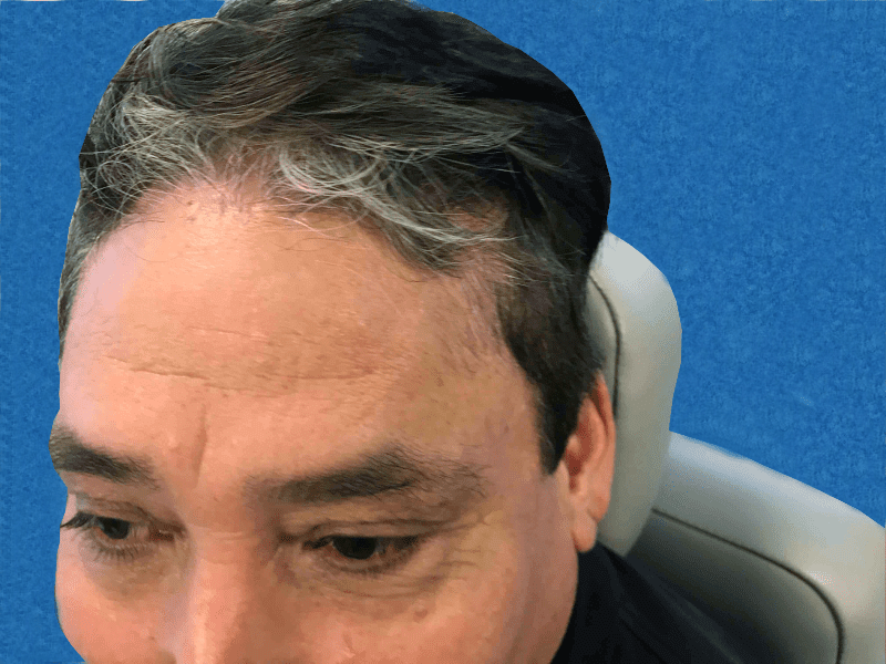 Mohs Patient Scalp 02 After - 2