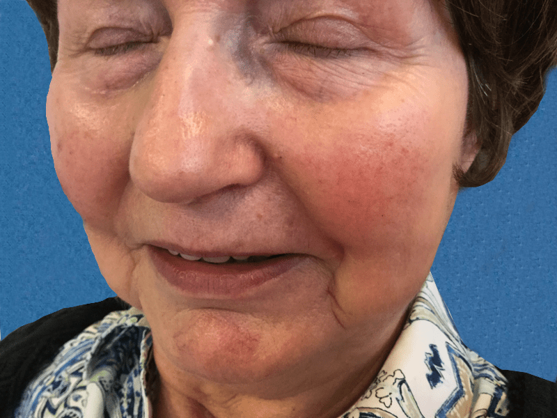 Mohs Lip Patient 11 Before