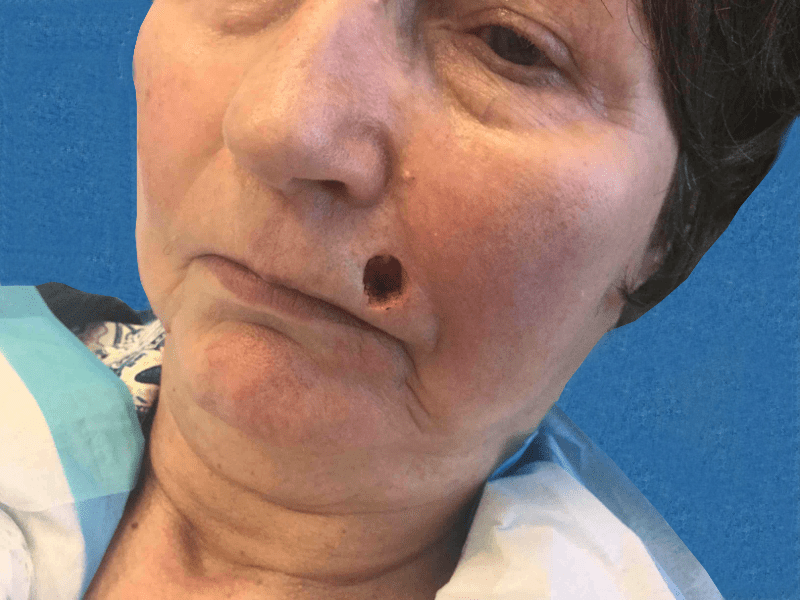 Mohs Lip Patient 11 After