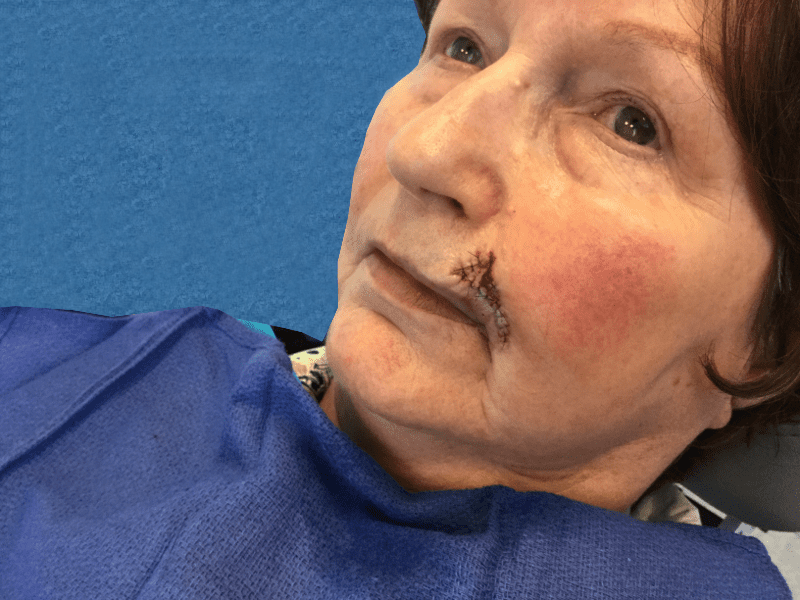 Mohs Lip Patient 11 Before - 2