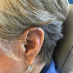 Mohs Ear Patient 11 Thumbnail Before