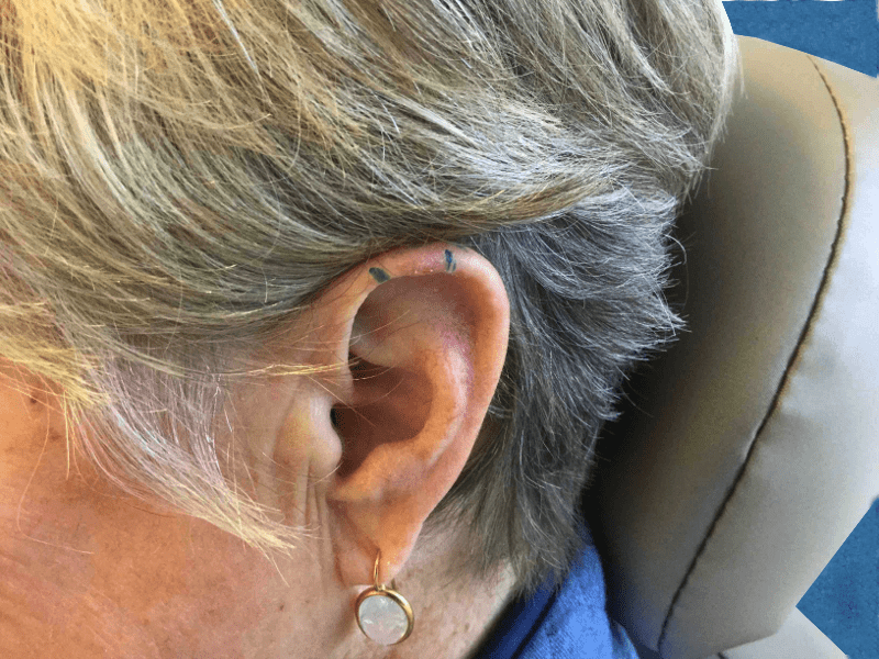 Mohs Ear Patient 11 Before