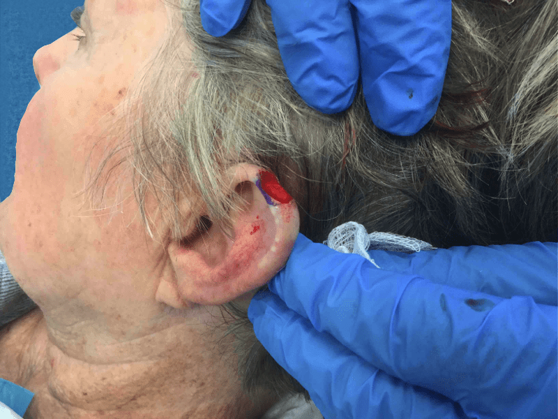 Mohs Ear Patient 11 After