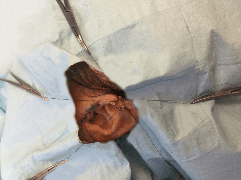 Mohs Ear Patient 11 Before - 2